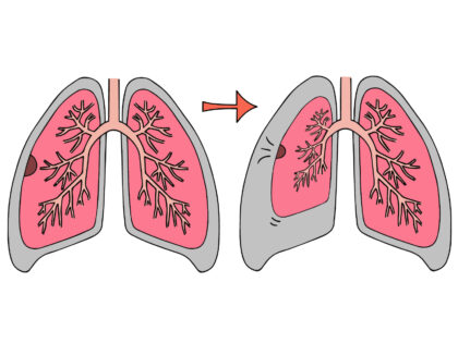 肺がパンクしてしぼんでしまった状態です。 咳・くしゃみ・筋トレの息こらえなどで発症する場合もあります。