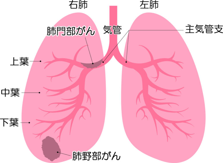 肺がん